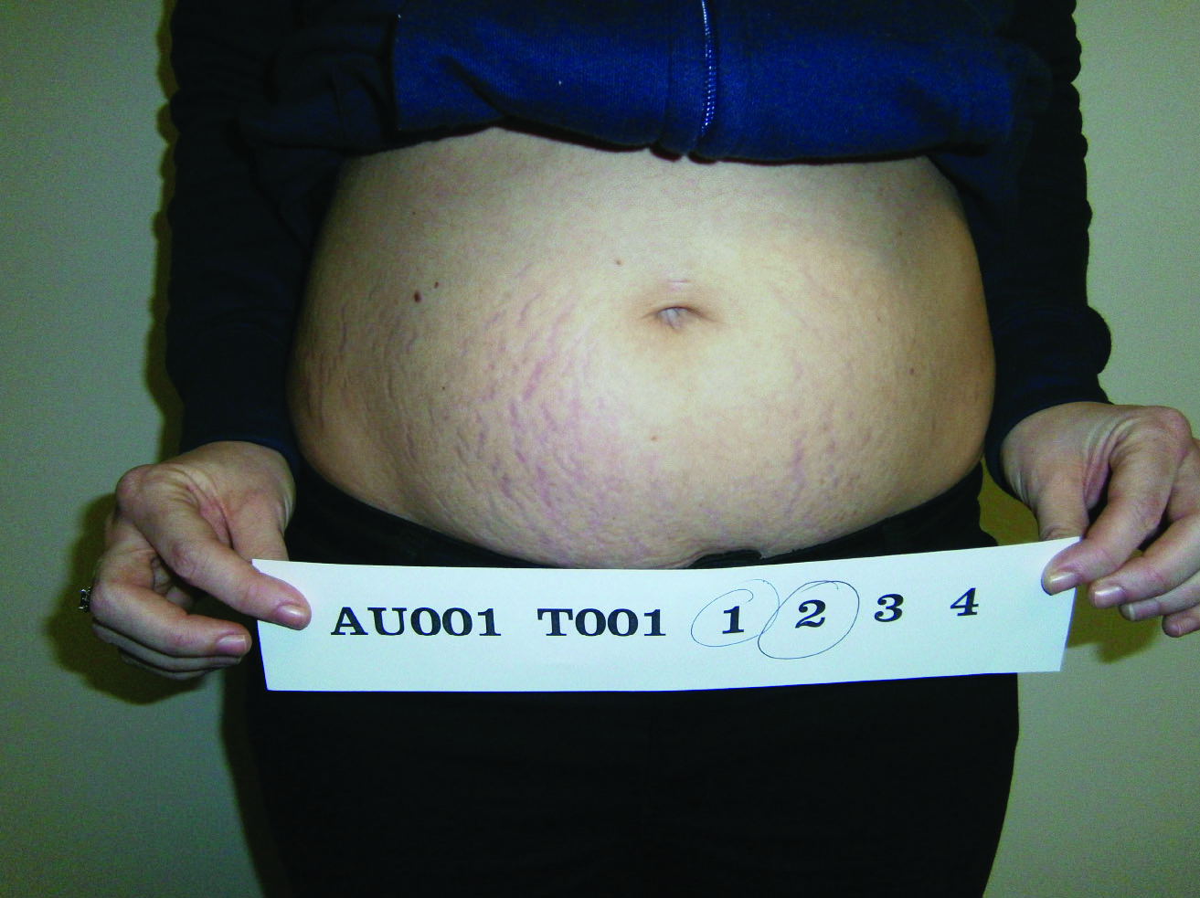 Before treatment